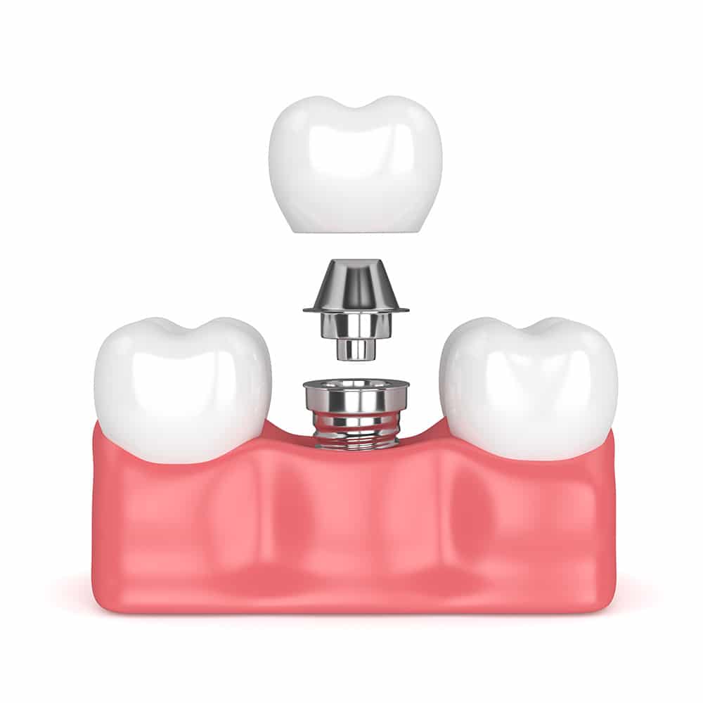 Dental Implants Facts and Statistics 20242023,2018, 20192020 Trend
